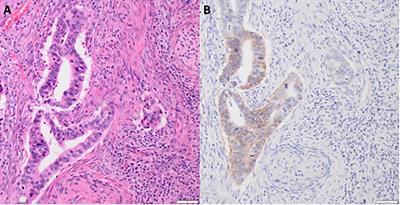 Human epidermal growth factor receptor 2 expression in women with uterine cervix adenocarcinoma from Appalachian Kentucky